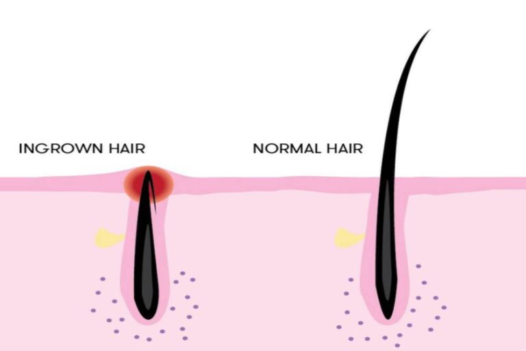 Ingrown Hairs: Causes, Symptoms & Treatment