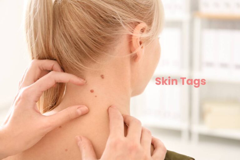 What Are Skin Tags? – Causes, And Home Remedies