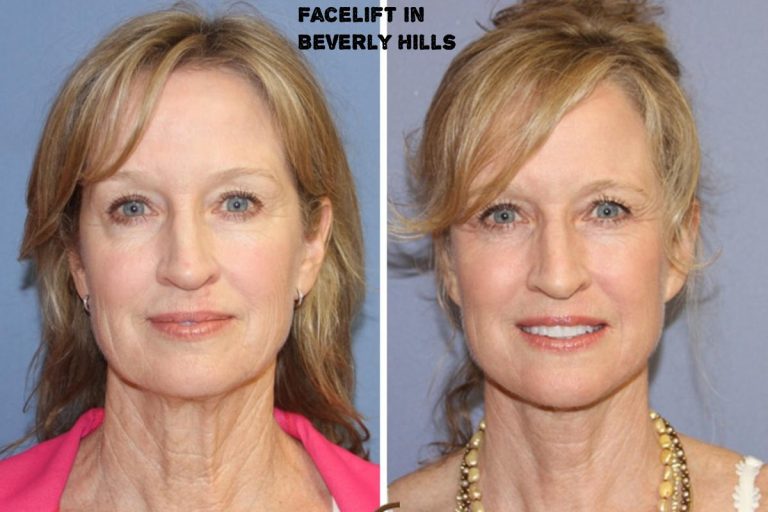 What Should You Know About the Facelift in Beverly Hills?