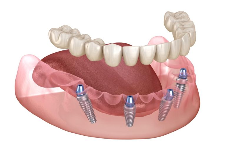 What Are All-on-4 Implants for Teeth?
