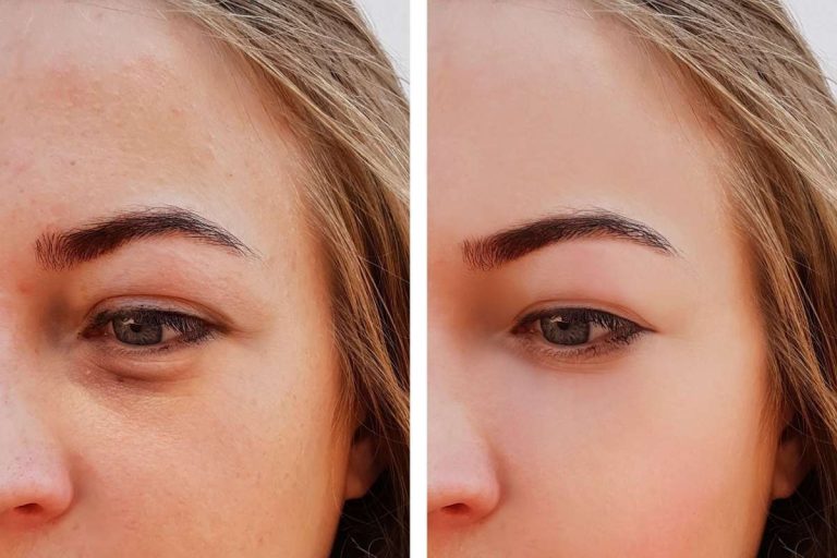 Remove Dark Circles Under Eyes at Home