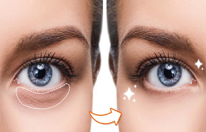 how to get rid of dark circles under eyes fast