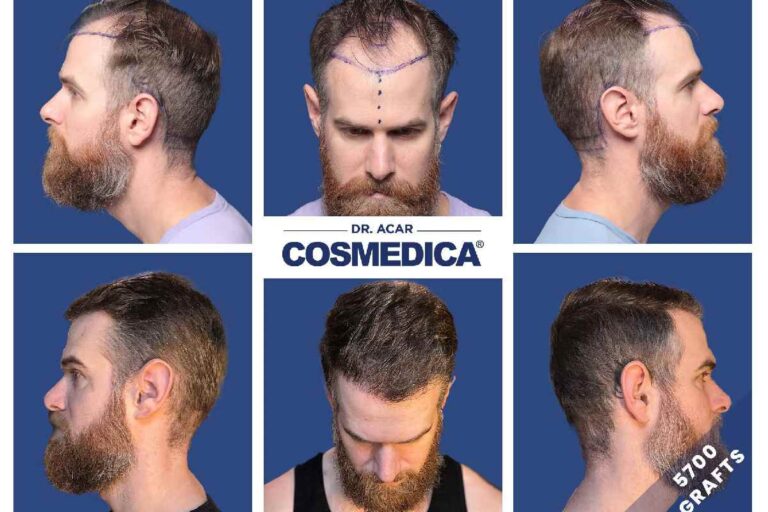 Hair Transplant Before and After Results – Cosmedica Clinic